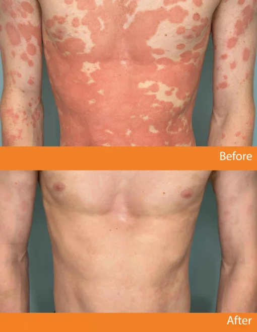 Cvreoz® Psoriasis Bee Venom Care Spray
