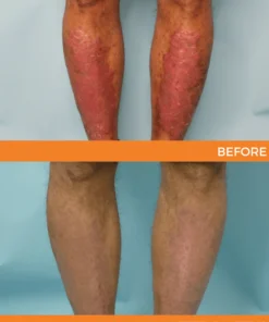 Cvreoz® Psoriasis Bee Venom Care Spray