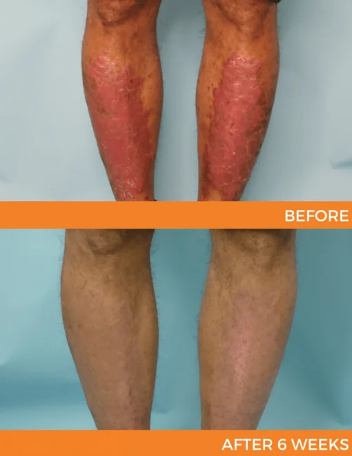 Cvreoz® Psoriasis Bee Venom Care Spray