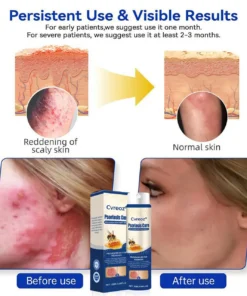 Cvreoz® Psoriasis Cure Bee Venom Treatment Spray