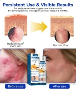 Cvreoz® Psoriasis Heal Bee Venom Spray