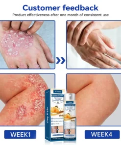 Cvreoz® Psoriasis Heal Bee Venom Spray