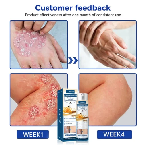 Cvreoz® Psoriasis Heal Bee Venom Spray