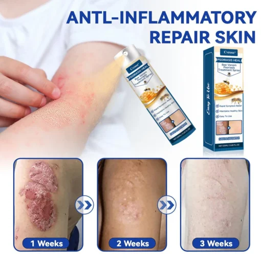 Cvreoz® Psoriasis Heal Bee Venom Spray
