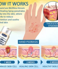Cvreoz® PsoriasisCare Mellifera Venom Skin Healing Spray