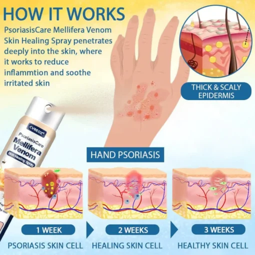 Cvreoz® PsoriasisCare Mellifera Venom Skin Healing Spray
