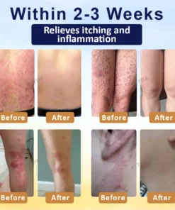 Cvreoz® PsoriasisCare Mellifera Venom Skin Healing Spray