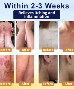 Cvreoz® PsoriasisCare Mellifera Venom Skin Healing Spray