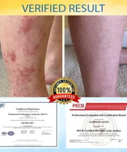 Cvreoz® PsoriasisCare Mellifera Venom Skin Healing Spray