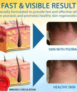 Cvreoz® PsoriasisCare Mellifera Venom Skin Healing Spray