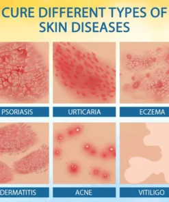 Cvreoz® PsoriasisCare Mellifera Venom Skin Healing Spray