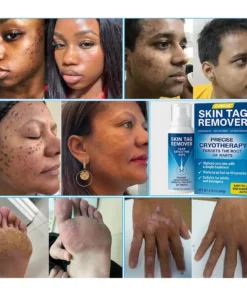 Cvreoz® TagRecede Cryo Treatment Spray