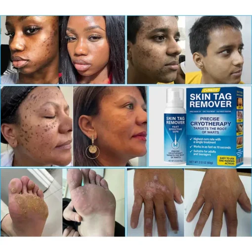 Cvreoz® TagRecede Cryo Treatment Spray