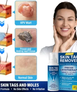 Cvreoz® TagRecede Cryo Treatment Spray