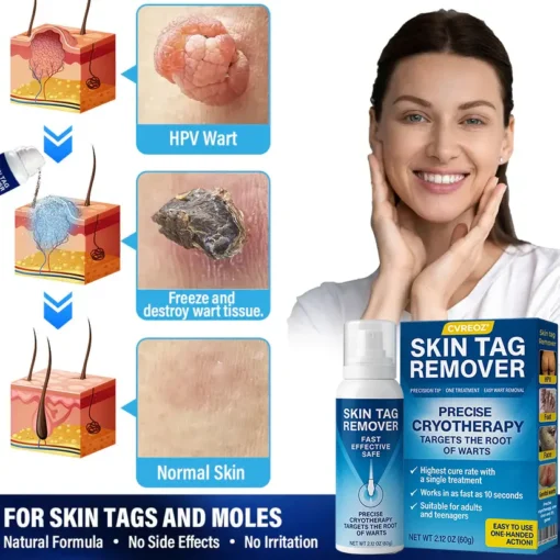 Cvreoz® TagRecede Cryo Treatment Spray