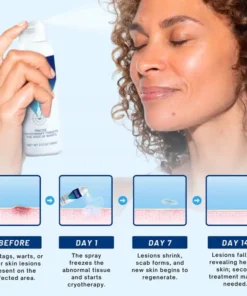 Cvreoz® TagRecede Cryo Treatment Spray