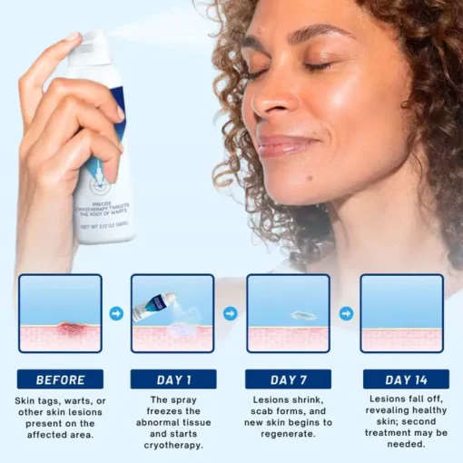 Cvreoz® TagRecede Cryo Treatment Spray