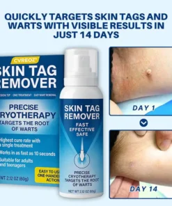 Cvreoz® TagRecede Cryo Treatment Spray