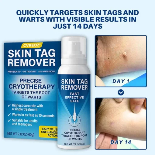 Cvreoz® TagRecede Cryo Treatment Spray