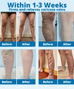 Cvreoz® VeinErase MicroNeedle Repair Patch