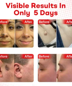 Cvreoz®MicroNeedle BotanicSkin Tag Removal Patch