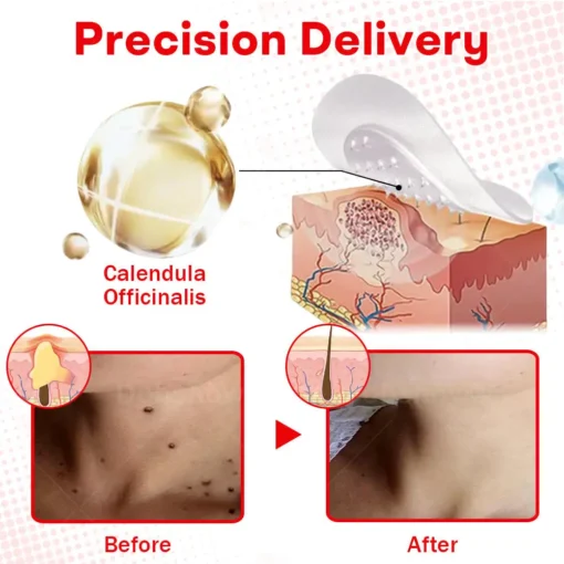 Cvreoz®MicroNeedle BotanicSkin Tag Removal Patch