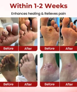 CVREOZ® DiaCare Diabetic Treatment Cream