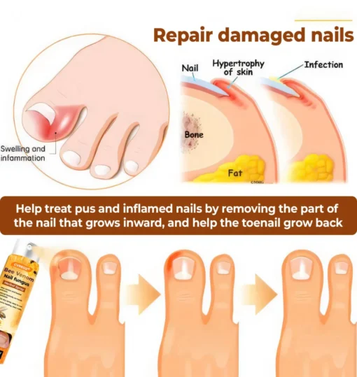 Crveoz® Bee Venom Nail Fungus Herbal Spray