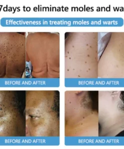 Cvreoz® Bee Venom Mole and Wart Treatment Cream