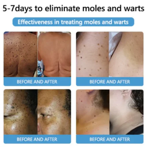 Cvreoz® Bee Venom Mole and Wart Treatment Cream