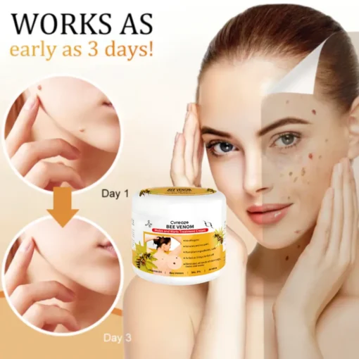 Cvreoz® Bee Venom Mole and Wart Treatment Cream