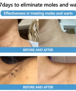 Cvreoz® Bee Venom Mole and Wart Treatment Cream