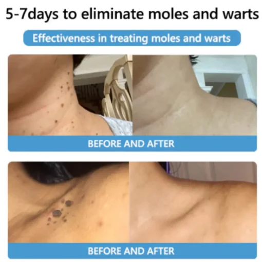 Cvreoz® Bee Venom Mole and Wart Treatment Cream