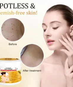 Cvreoz® Bee Venom Mole and Wart Treatment Cream