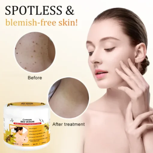Cvreoz® Bee Venom Mole and Wart Treatment Cream