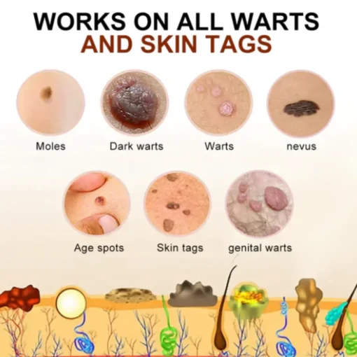 Cvreoz® Bee Venom Mole and Wart Treatment Cream