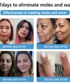 Cvreoz® Bee Venom Mole and Wart Treatment Cream