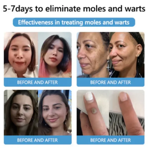 Cvreoz® Bee Venom Mole and Wart Treatment Cream