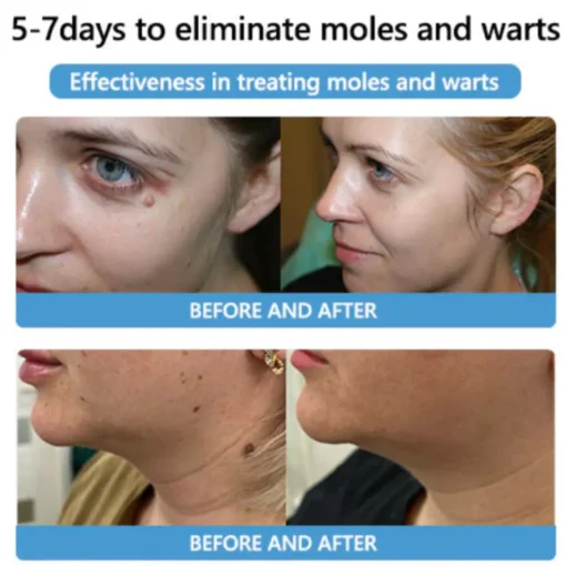 Cvreoz® Bee Venom Mole and Wart Treatment Cream