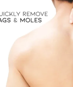 Cvreoz® Bee Venom Mole and Wart Treatment Cream