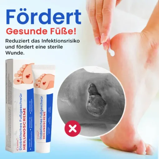 Cvreoz® Diabetisches Fußgeschwür Heilungscreme