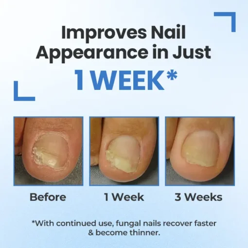 Cvreoz® MycoErase Nail Revive Pen