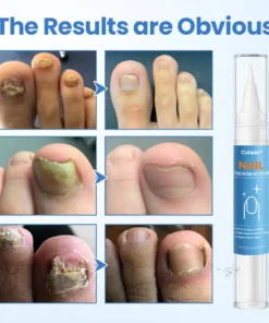 Cvreoz® MycoErase Nail Revive Pen