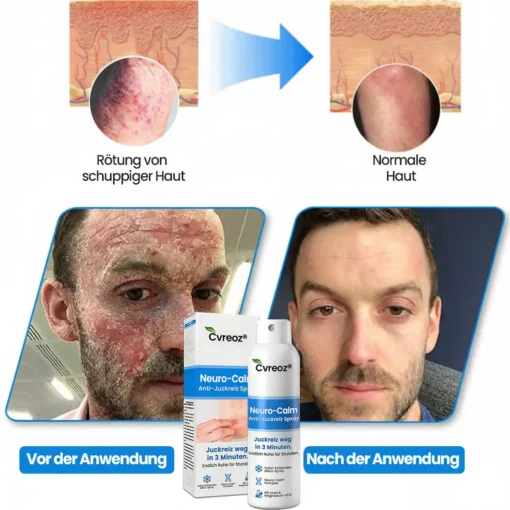 Cvreoz® Neuro-Calm Anti-Juckreiz Akut-Spray