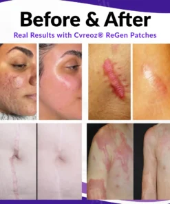 Cvreoz® ReGen Microneedles Pro Patches