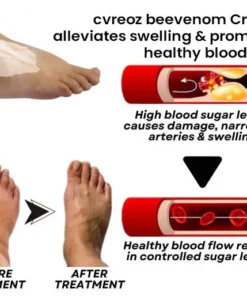 Cvreoz® Bee Venom Diabetic Wounds Treatment Cream