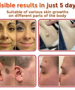 Cvreoz® MicroNeedle Botanic Skin Tag Removal Patch