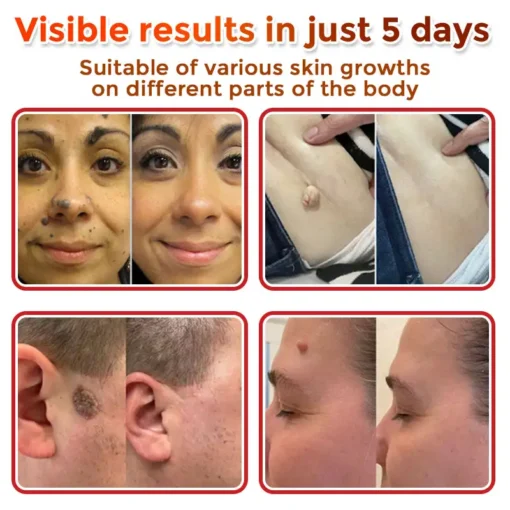Cvreoz® MicroNeedle Botanic Skin Tag Removal Patch