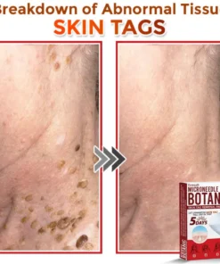 Cvreoz® MicroNeedle Botanic Skin Tag Removal Patch