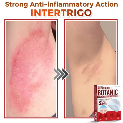 Cvreoz® MicroNeedle Botanic Skin Tag Removal Patch